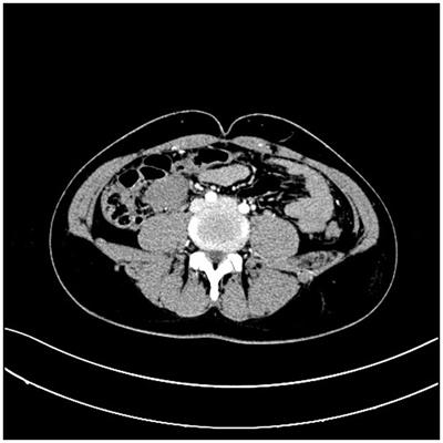 Case report: A rare case of desmoid-type fibromatosis originating in the small intestine